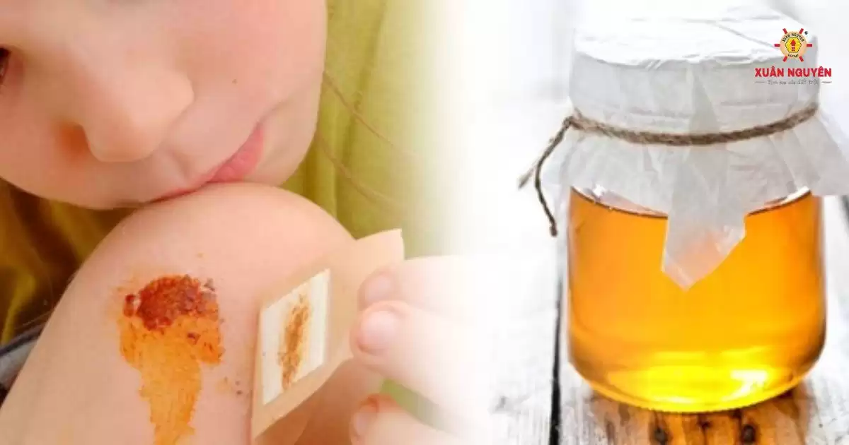 mật ong hoa xuyến chi - trợ thủ đắc lực trong việc chữa bỏng và làm lành vết thương